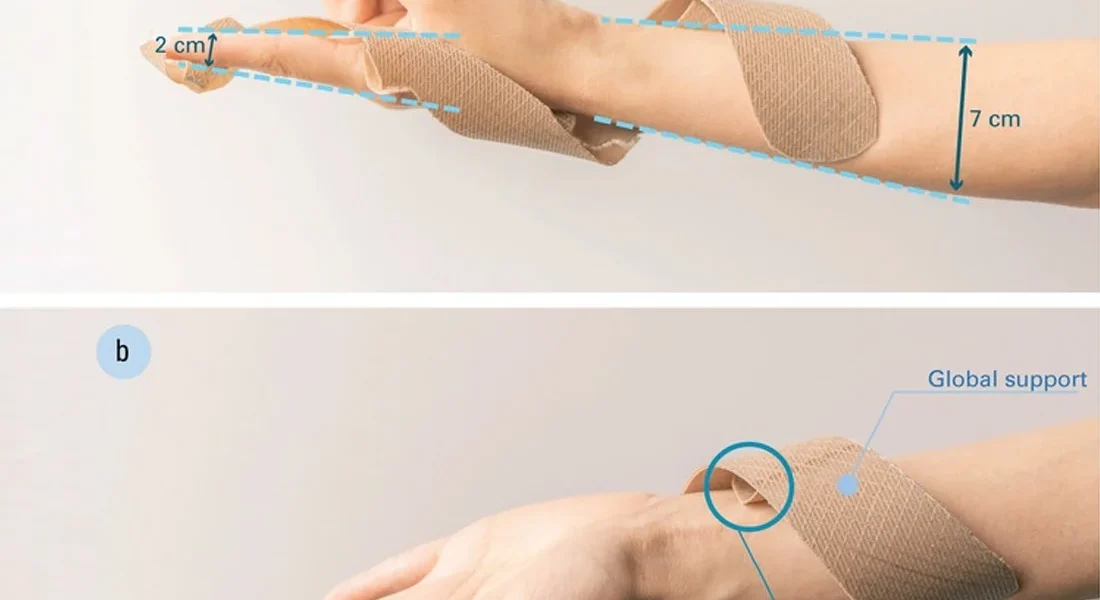 4D-printed-self-tightening-wrist-splint-by-University-of-Freiburg-Researchers