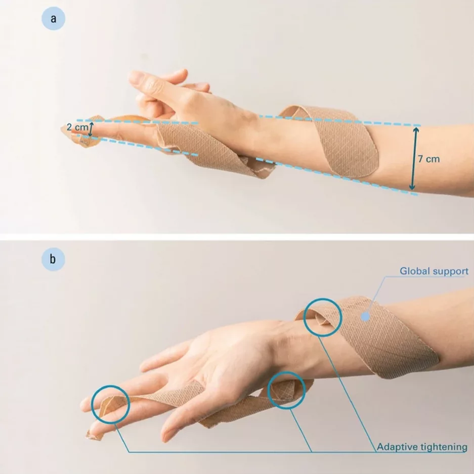 4D-printed-self-tightening-wrist-splint-by-University-of-Freiburg-Researchers