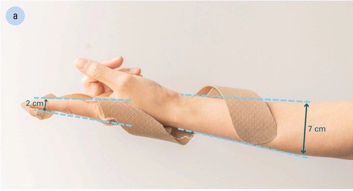 self adjusting 4D printed wrist splint